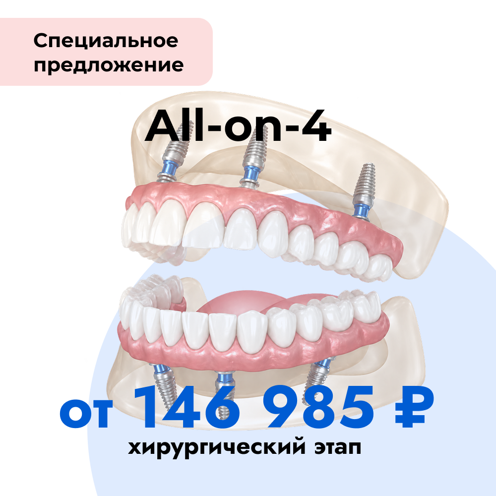 Имплантация All-ON-4
